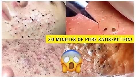 Экстракты Blackhead на Youtube — самое странное и удовлетворяющее экстрактное видео