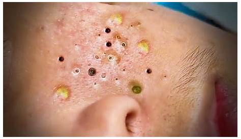 Hari Spa Blackheads?????????????????????????????????????????????????????????????????????????????????????????????????????????????????????????????????????????????????????????????????????????????????????????????????????????????????????????????????????????????????????????