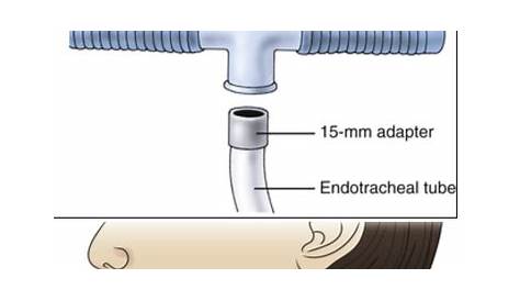 Trach Collar Vs T Piece Pp Chaper 30 Powerpoin Presenaion скачать бесплатно Id2295253