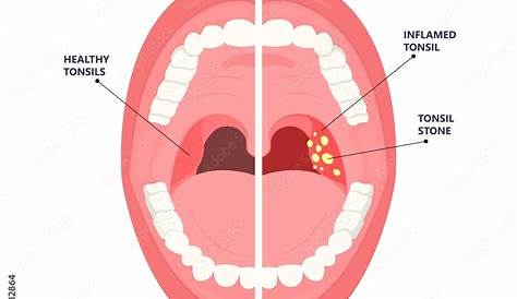 Icd 10 Tonsil Stones Crypts Virus Gland Strep Throat Sore Enlarged Lymph (недоступная ссылка — история).