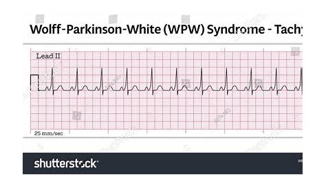 Icd 10 Code for Wolffparkinsonwhite Wolffparkinson White Syndrome Wpw Atrioventricular Reentry (недоступная ссылка)