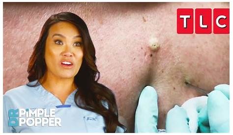 Новый Dr Pimple Popper Youtube Blackheads’ Popping Extravaganza!