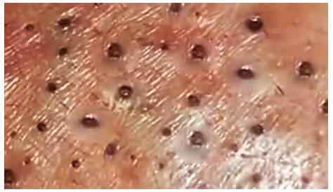 Лучшие клипы Blackhead Crazy Huge And Pimple