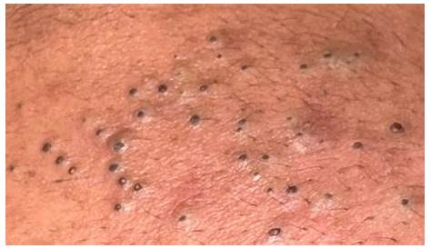 Extreme Blackhead выкладывает новые видео S & Removal 2022 на Youtube