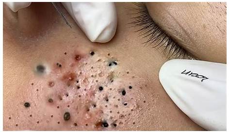 Big Cystic Acne Removal Видео Blackheads Extraction Blackheads & Milia Whiteheads