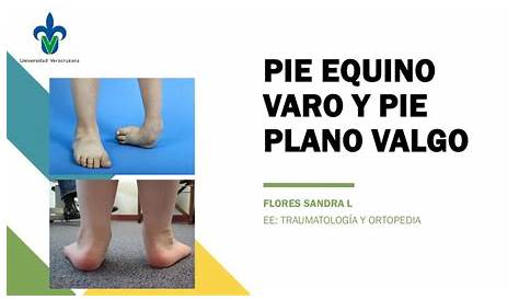 Пирог ортопедиатрический (Pie Adquirido Orthopediatrica)