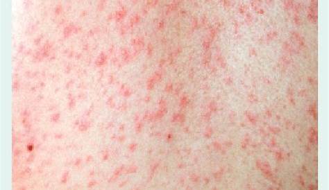Macular Rash Icd 10 Макулопапулезная корь