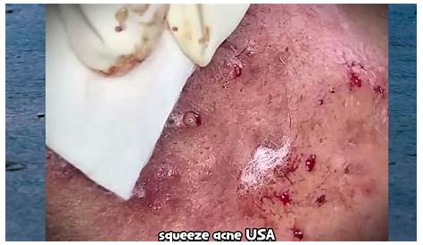 Pimple Popping Videos Новый Youtube Enilsa Brown Blackheads Назад Удаление Blackhead Extracti