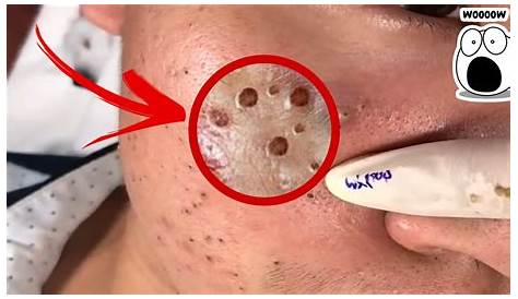 Youtube Videos Blackhead Removal Странно устраивает компиляция