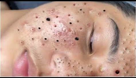 Blackhead Removal Nguyen специально удаляется на Nose Loan Youtube