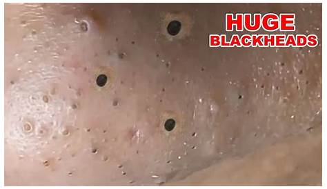 Видео-экстракция Blackheads на Youtube Nose Part 1