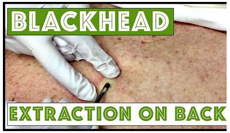 Blackhead Cyst Removal Videopitpoint Подробнее о методах извлечения S в Hd Youtube
