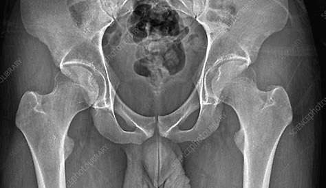 Male Groin Male Normal Male Hip Xray 50 лет назад