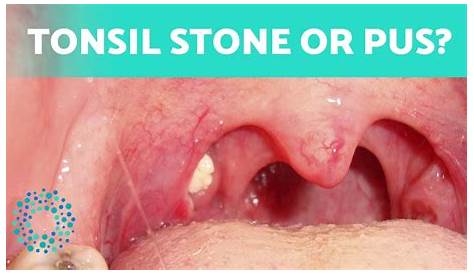 Fleshy Skin на Tonsil — еще одно видео Tsil Stes Youtube