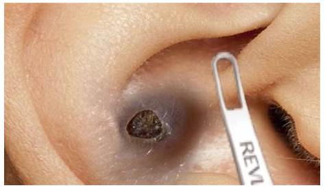 Удаление Blackhead Best of Deep Big в ухе