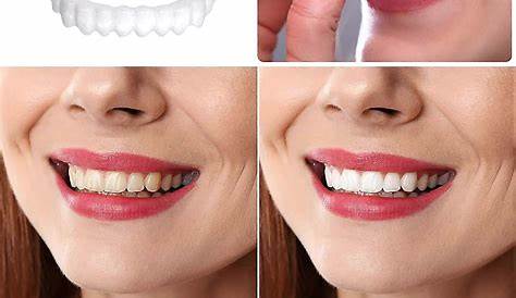 SnapOn Dentures & Страховое покрытие: помогает ли это?