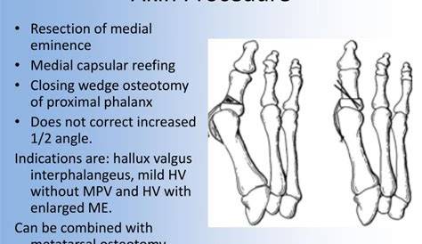Cpt Code Akin Osteotomy Ppt Hallux Valgus The Wrath of Fancy Shoes Powerpoint
