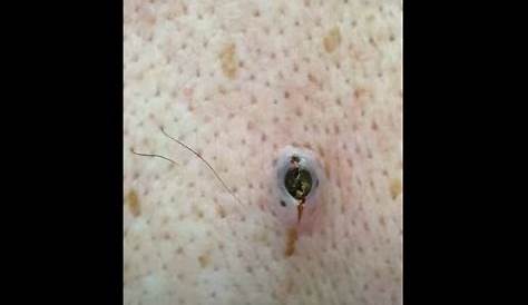 Большая страница Blackhead Removalsfav создает экстракцию доктора Паймпла Поппера