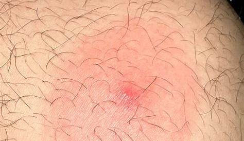 Blisters On Buttocks Pictures Painful Bumps Cheek (недоступная ссылка — история).