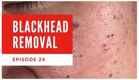 Видео с удалением Blackhead в сентябре 2023 года на Youtube: Facial and Excellent Extraction Ep24