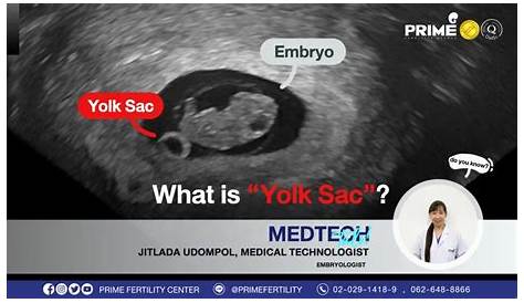 Означает ли большой желточный мешок синдром Дауна, что такое « Sc»?