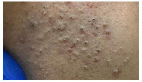 Anilsa Brown опубликовала новое видео от Enilsa Pimple Popping