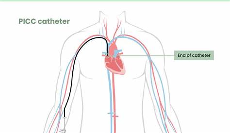 Picc Line Placement Icd 10 Катетер
