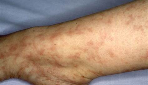 Фотографии раскисшей кожи на руках и ногах Livedo Reticularis вызывает лечение