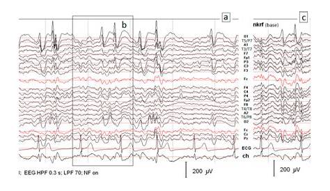 Xl Spike на основе статистической модели Eeg Classificati для выявления пациентов