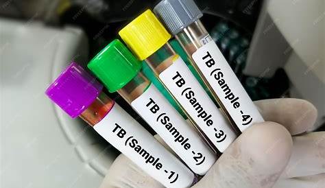 Tb Test Minute Clinic Золотая кровь туберкулеза