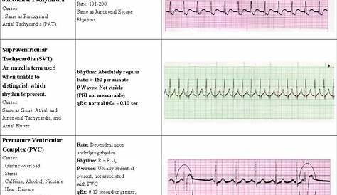 Aha Acls Quizlet Rhythms Pg 4 of 7 Saving American Hearts Inc.